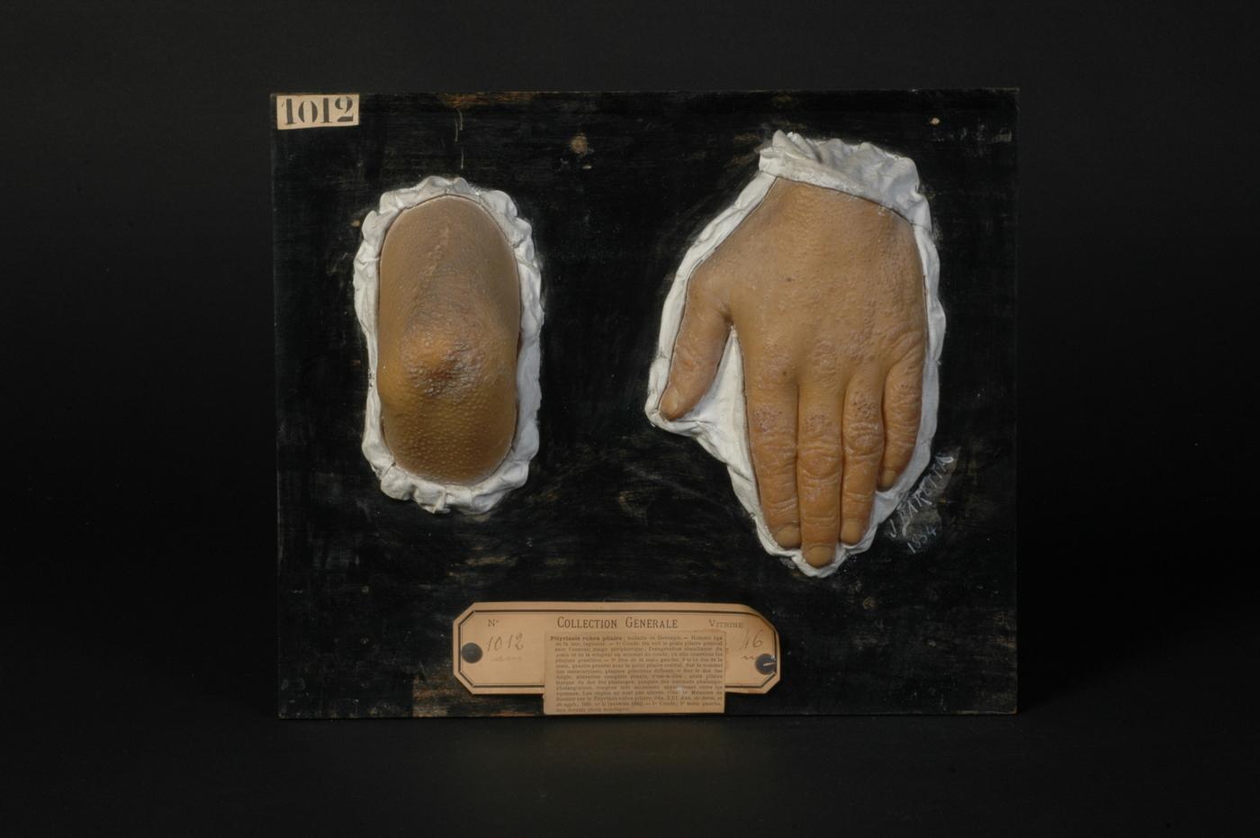 Le moulage n°1012 de la « maladie de Devergie » conservé au musée des moulages de l’hôpital Saint-Louis.