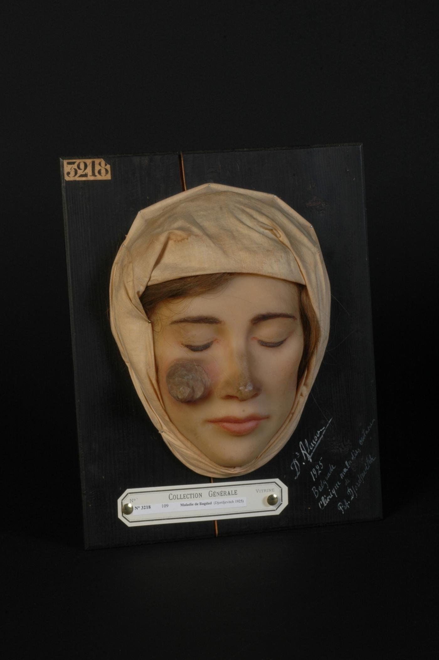 Le moulage n°3218 de la « maladie de Bagdad » conservé au musée des moulages de l’hôpital Saint-Louis.